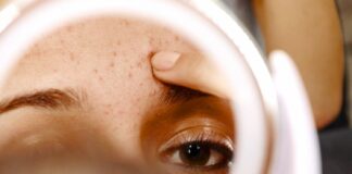 Acne: Causes, Symptoms, Treatment, and Prevention Tips